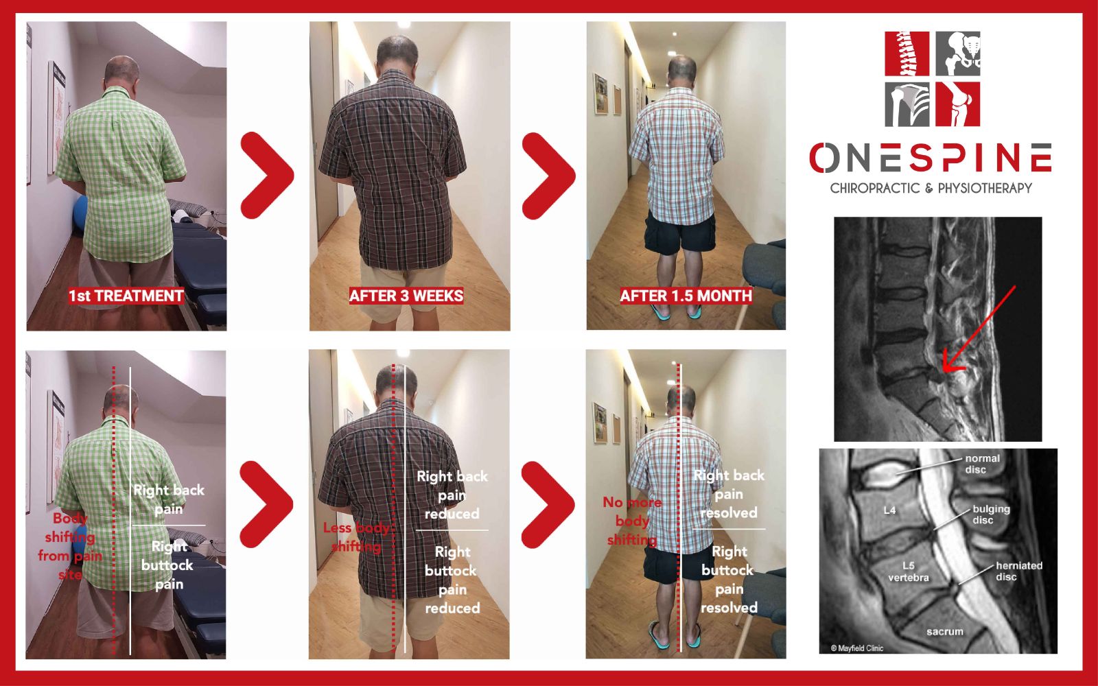 Actual One Spine patient X-ray before and after image showing spinal alignment changes